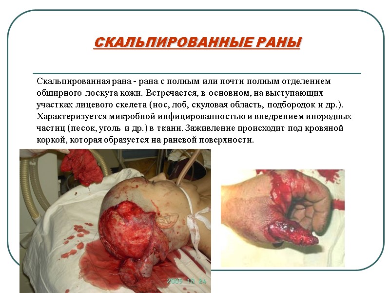 СКАЛЬПИРОВАННЫЕ РАНЫ Скальпированная рана - рана с полным или почти полным отделением  обширного